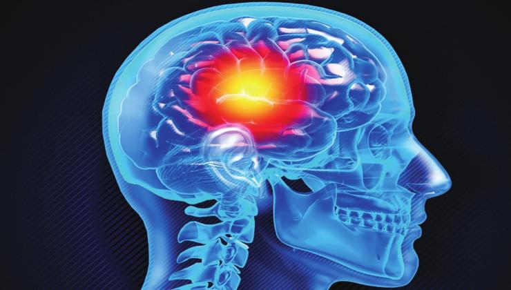Risk factors for stroke, including those you can control