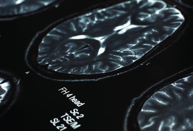 What to know about stroke