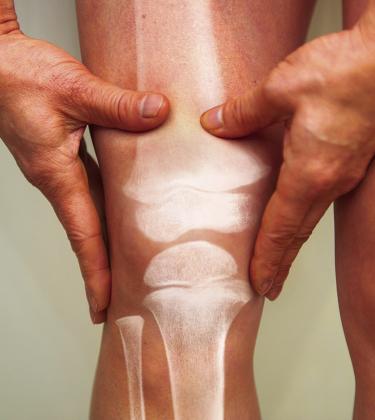 Start preventing osteoporosis now