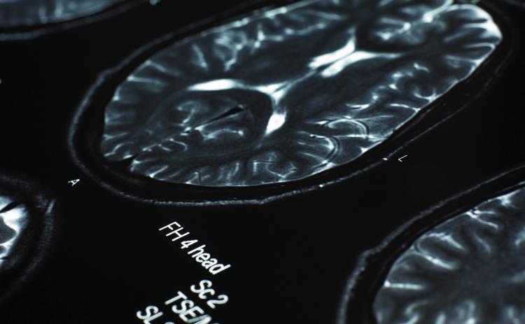 What to know about stroke