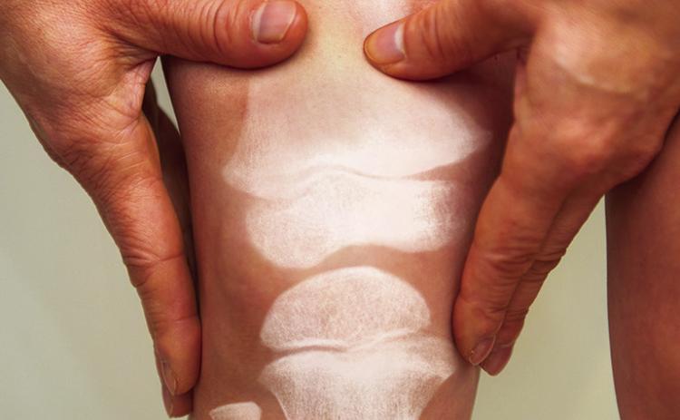 Start preventing osteoporosis now